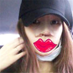 玻尿酸注射隆鼻手術(shù)三個月了，分享我的恢復(fù)過程，還有對比照片哦~