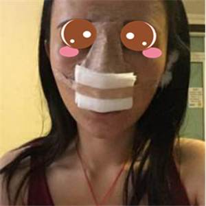 分享我的硅膠假體隆鼻手術(shù)恢復(fù)過程和前后對比果圖片哦~