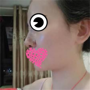 分享我的硅膠假體隆鼻手術(shù)恢復(fù)過程和前后對比果圖片哦~