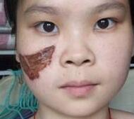 激光去胎記——長達(dá)一年的激光太田痣青色胎記緩解過程分享