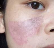 激光去胎記——長達(dá)一年的激光太田痣青色胎記緩解過程分享