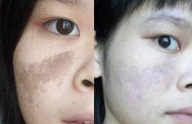 激光去胎記前后對比圖