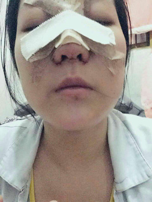 做了隆鼻整形手術，給大家分享一下手術過程，還有對比照片哦