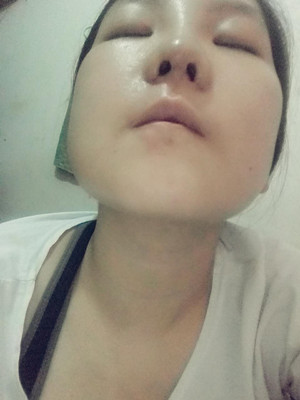 做了隆鼻整形手術，給大家分享一下手術過程，還有對比照片哦
