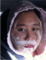 分享下頜角整形手術(shù)前后過程，還有對比照哦