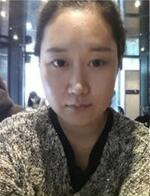 分享下頜角整形手術(shù)前后過程，還有對比照哦