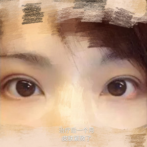 做了眼部電波l皮，一下子年輕了不少啊