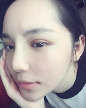 梨花雨隆鼻整形的恢復(fù)經(jīng)歷