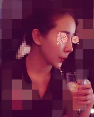 隆鼻失敗修復(fù)后整給鼻形很精致，鄭志敏醫(yī)生做的