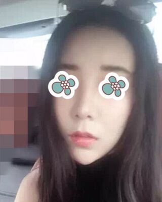 隆鼻失敗修復(fù)后整給鼻形很精致，鄭志敏醫(yī)生做的