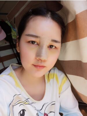 硅膠隆鼻+耳軟骨墊鼻尖后美到朋友認(rèn)不出