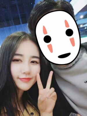 硅膠隆鼻+耳軟骨墊鼻尖后美到朋友認(rèn)不出