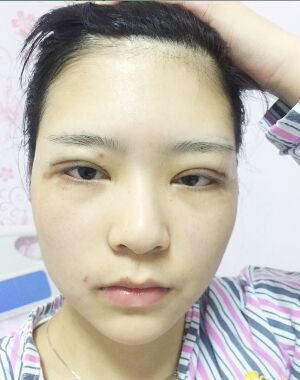 全切雙眼皮修復(fù)后恢復(fù)成漂亮的眼睛了