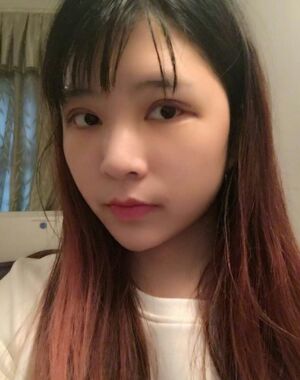 全切雙眼皮修復(fù)后恢復(fù)成漂亮的眼睛了