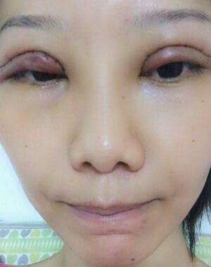 東莞美立方張克醫(yī)生給我做的全切雙眼皮超**