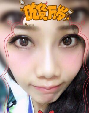 東莞美立方張克醫(yī)生給我做的全切雙眼皮超**