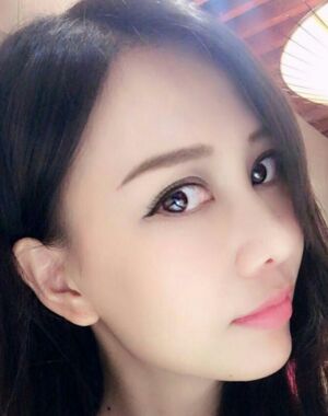 東莞美立方張克醫(yī)生給我做的全切雙眼皮超**