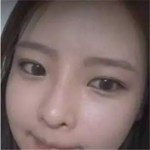 做了磨顴骨和面部脂肪填充，分享前后對比果圖片哦~