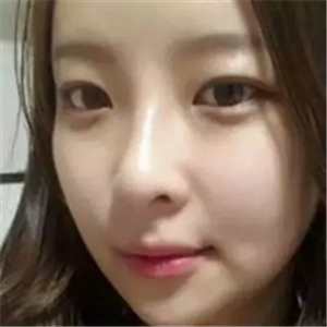 做了磨顴骨和面部脂肪填充，分享前后對比果圖片哦~