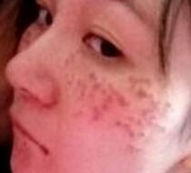 激光去雀斑價格3800元，術(shù)后恢復(fù)過程和術(shù)后注意事項分享