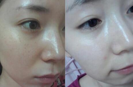 激光去雀斑手術(shù)前后對比照