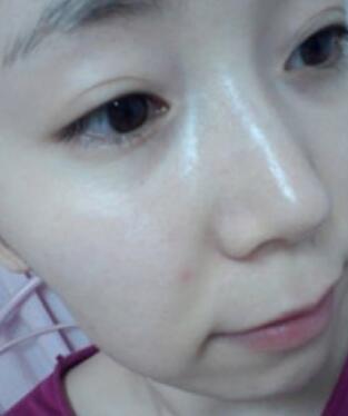 激光去雀斑手術(shù)后照片