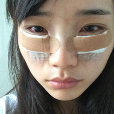 自體脂肪填充淚溝手術(shù)前后對(duì)比照片和恢復(fù)過程分享