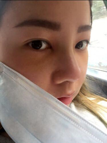 做了隆鼻整形手術(shù)果真的很不錯(cuò) 大家快來(lái)看看吧