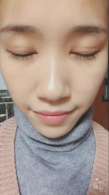 做了全切雙眼皮 整個(gè)眼睛都變大了氣質(zhì)也不一樣了