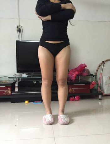 大腿吸脂手術(shù)真的是解決很難減下去的良藥 看我得果就知道