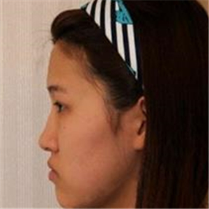 去年做了隆鼻整形，分享恢復(fù)過程和前后對比果圖片哦，