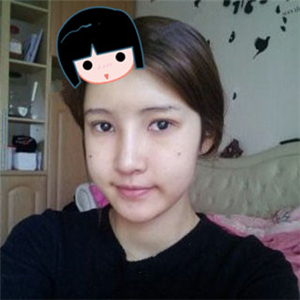 去年做了隆鼻整形，分享恢復(fù)過程和前后對比果圖片哦，