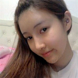 去年做了隆鼻整形，分享恢復(fù)過程和前后對比果圖片哦，