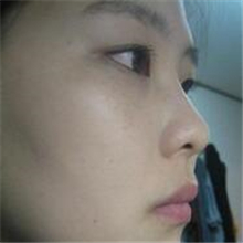 分享我的雙眼皮+開(kāi)內(nèi)眼角+切除鼻中隔軟骨整形手術(shù)恢復(fù)經(jīng)歷~