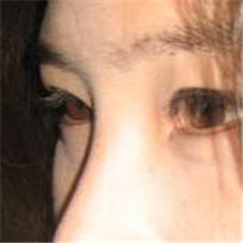 分享我的雙眼皮+開(kāi)內(nèi)眼角+切除鼻中隔軟骨整形手術(shù)恢復(fù)經(jīng)歷~