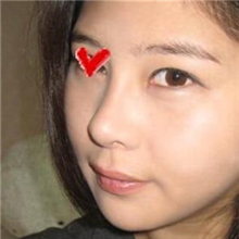 分享我的雙眼皮+開(kāi)內(nèi)眼角+切除鼻中隔軟骨整形手術(shù)恢復(fù)經(jīng)歷~