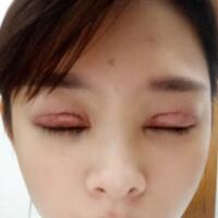 割雙眼皮開眼角價(jià)格12000元，眼部整形對(duì)比照片和恢復(fù)過(guò)程分享