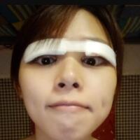 割雙眼皮開眼角價(jià)格12000元，眼部整形對(duì)比照片和恢復(fù)過(guò)程分享