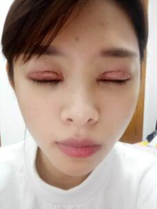 雙眼皮+開眼角手術恢復過程圖