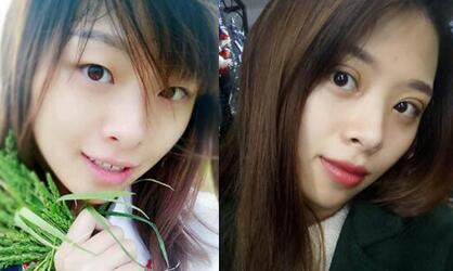 恢復過程中的割雙眼皮開眼角手術前后對比圖