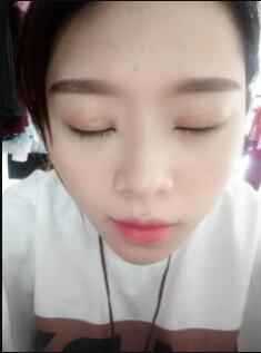 雙眼皮和開眼角慢慢恢復