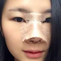 膨體隆鼻整形價(jià)格11800元，隆鼻果和恢復(fù)過(guò)程分享
