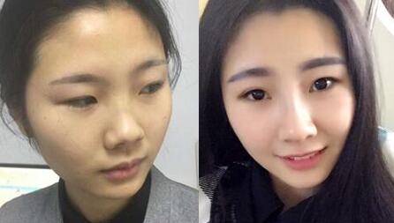 膨體隆鼻手術(shù)前后對比圖