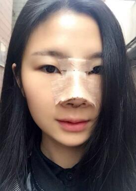 膨體隆鼻手術(shù)圖片和過程分享