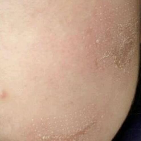 兩次激光祛疤過程圖片分享給大家做割參考