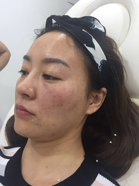 蛋白線面部埋埋蛋白線.提升，改良我的皮膚問(wèn)題