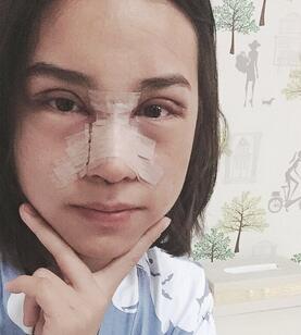 上海韓鏡網(wǎng)紅套餐半個月經(jīng)歷 雙眼皮多項整形+隆鼻整形+脂肪填充