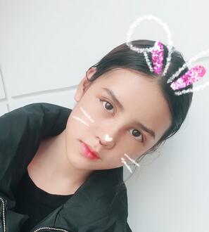 上海韓鏡網(wǎng)紅套餐半個月經(jīng)歷 雙眼皮多項整形+隆鼻整形+脂肪填充