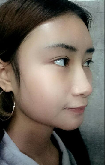 馮斌做的自體脂肪全臉填充大家?guī)臀铱纯垂趺礃? /> </a>
										<a href=