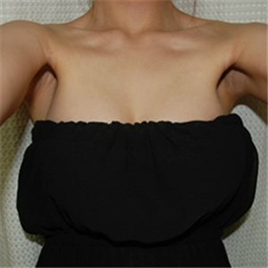 去年底做了自體脂肪豐胸手術，分享術后果照片~